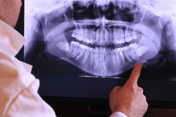 Best Emergency Wisdom Teeth Removal in North Plymouth, MA
